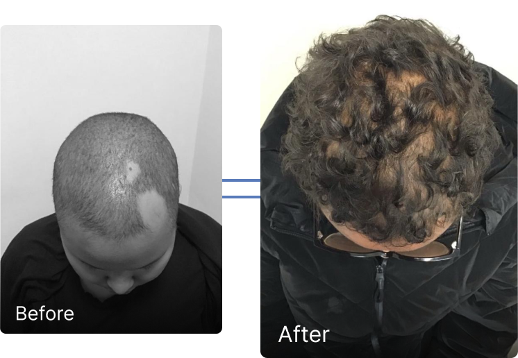 Before and after hair restoration